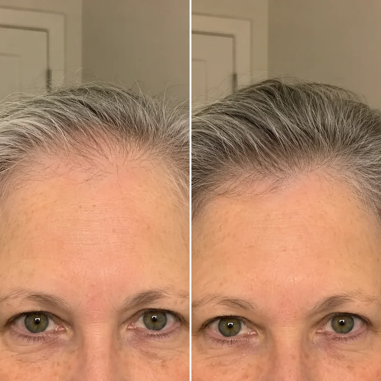 Denise W. before and after placeholder