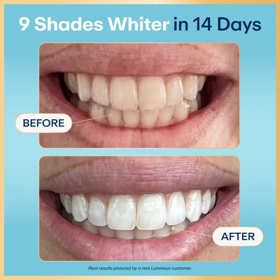 Before and after photograph of a customer's teeth published by Lumineux, captioned nine shades whiter in fourteen days.