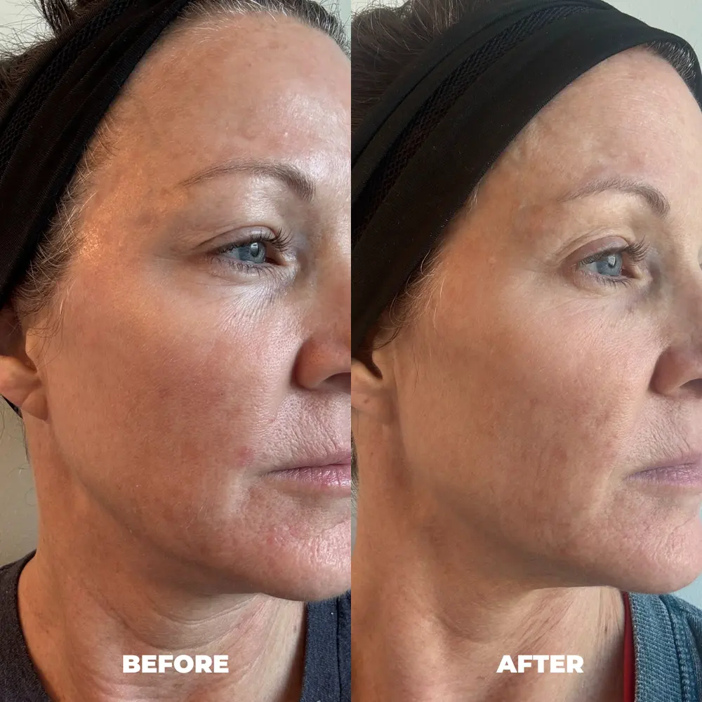 Customer before and after photos at four weeks, Anna T.